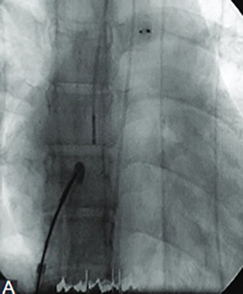 NRGTM RF powered transseptal needle: a useful technique for transcatheter atrial septostomy and Fontan fenestration: report of three cases