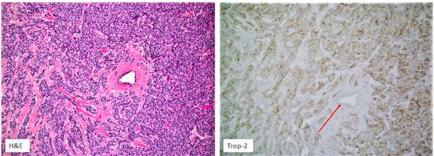 Trop-2 protein as a therapeutic target: A focused review on Trop-2-based antibody-drug conjugates and their predictive biomarkers