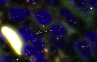 EWSR1 rearrangement in papillary thyroid microcarcinoma is related to classic morphology and the presence of small-cell phenotype