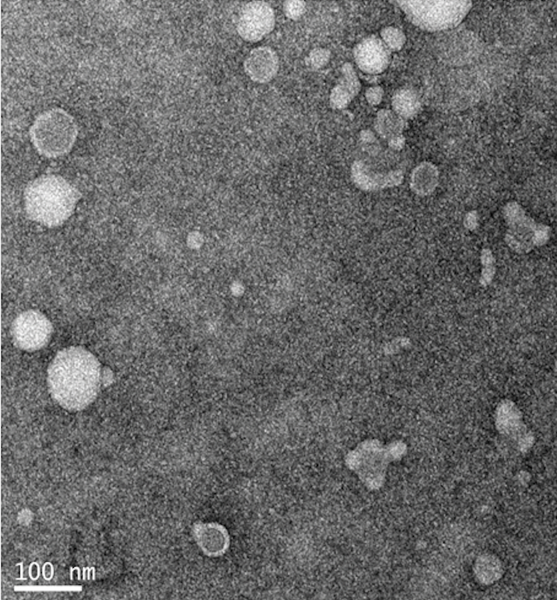 Plasma exosome-derived fragile-site associated tumor suppressor is a powerful predictor of prognosis in patients with ovarian cancer