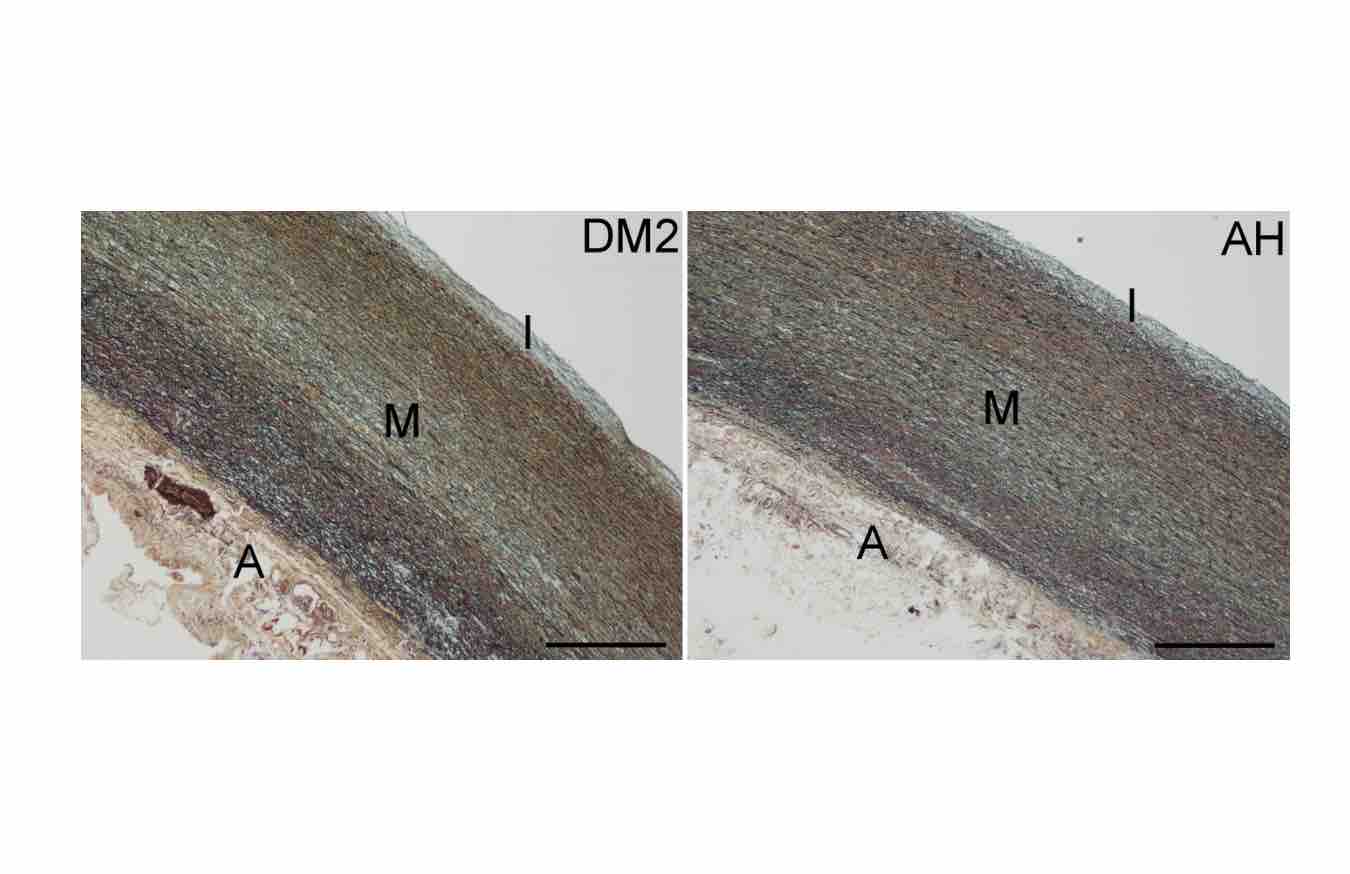 Inflammatory cells in the ascending aortic aneurysm in patients with type 2 diabetes versus patients with hypertension