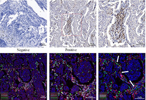 The Expression of VISTA on CD4+ T Cells Associate with Poor Prognosis and Immune Status in Non-small Cell Lung Cancer Patients