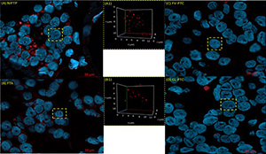 Three-dimensional telomere profiles in papillary thyroid cancer variants: a pilot study