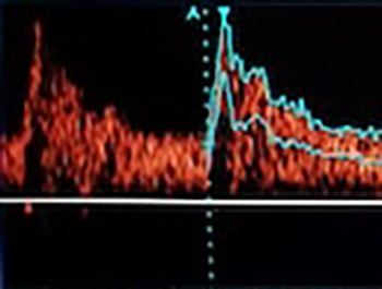 The association between brain natriuretic peptide and tissue Doppler parameters in children with hypertrophic cardiomyopathy