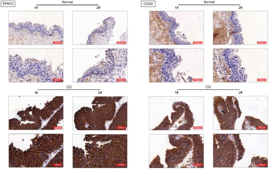 TPRG1 contributes to inflammation and cell proliferation of cystitis glandularis through regulating NF-кB/COX2/PGE2 axis