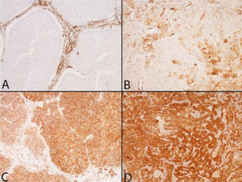 Association between NOTCH3 expression and the clinical outcome in the urothelial bladder cancer patients