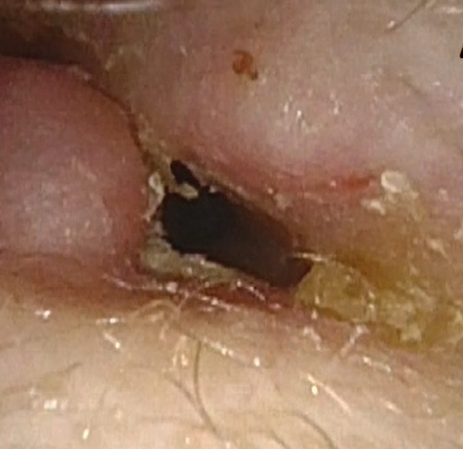 Thiersch graft follow-up with narrow band imaging for Acquired atresia of the external auditory canal: Canaloplasty with thiersch graft vs vascularization evaluated with narrow band imaging