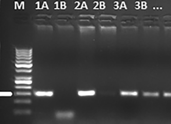 LGALS3 and AXIN1 gene variants playing role in the Wnt/ β-catenin signaling pathway are associated with mucinous component and tumor size in colorectal cancer