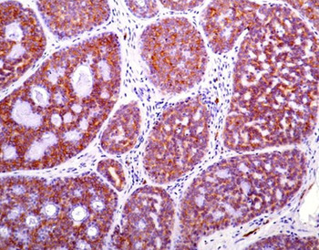 Role and Significance of c-KIT Receptor Tyrosine Kinase in Cancer: A Review