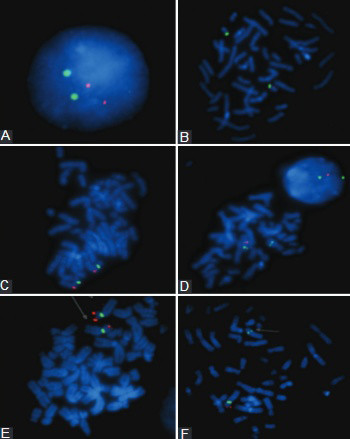 Diagnostics of common microdeletion syndromes using fluorescence in situ hybridization: single center experience in a developing country