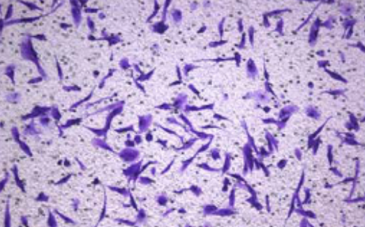 Dynamic network biomarker C1QTNF1 regulates tumor formation at the tipping point of hepatocellular carcinoma