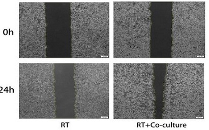 NRF2 promotes radioresistance by regulating GCLM and its unique immunoinvasive pattern