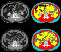 Metabolic score tool for personalized acute pancreatitis prognosis: A multicenter analysis