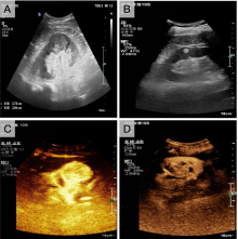 Clinical diagnostic value of contrast-enhanced ultrasound combined with microflow imaging in benign and malignant renal tumors: A retrospective cohort study