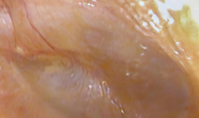 Clinical manifestations and outcomes of otitis media with effusion in adult patients following Omicron infection in China