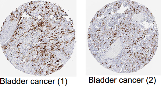 Cyclin B1: A potential prognostic and immunological biomarker in pan-cancer