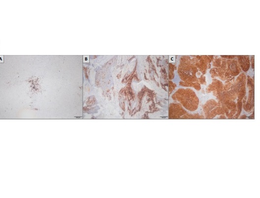 Effect of hypoxia-inducible factor-1 alpha expression on survival in patients with metastatic cervical squamous cell carcinoma treated with first-line chemotherapy and bevacizumab