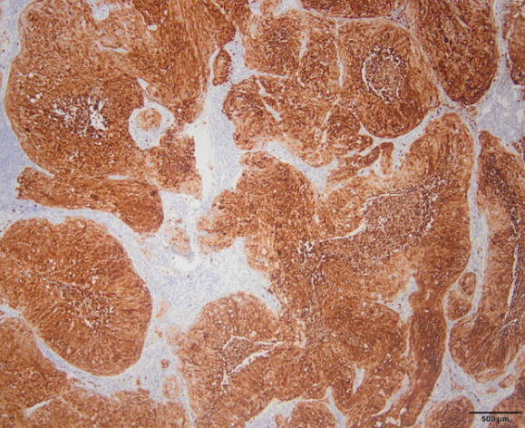 Effect of hypoxia-inducible factor-1 alpha expression on survival in patients with metastatic cervical squamous cell carcinoma treated with first-line chemotherapy and bevacizumab