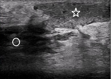 Is poor oral health a risk factor for idiopathic granulomatous mastitis?