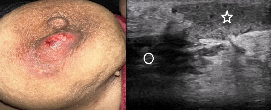 Is poor oral health a risk factor for idiopathic granulomatous mastitis?