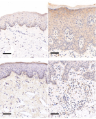 Identifying key inflammatory genes in psoriasis via weighted gene co-expression network analysis:  Potential targets for therapy