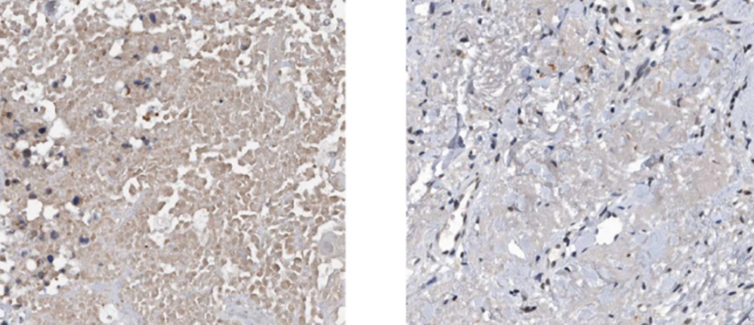 VIRMA promotes the progression of head and neck squamous cell carcinoma by regulating UBR5 mRNA and m6A levels