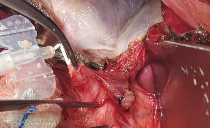 Lili-Hics trial: Efficacy of the lipid test in liver hydatid cyst surgery