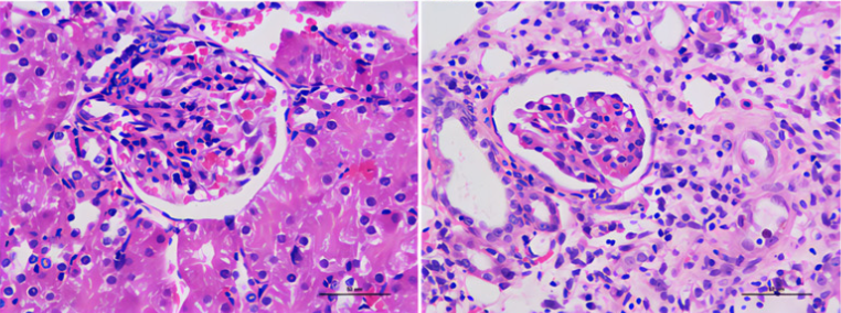 Tribbles pseudokinase 3 promoted renal fibrosis by regulating the expression of DNA damage inducible transcript 3 in diabetic nephropathy