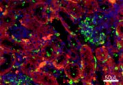Identification of novel biomarkers for lupus nephritis