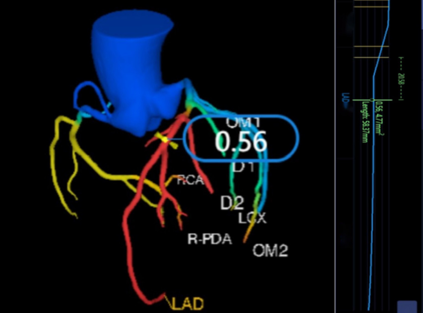 AI-assisted measurements of coronary computed tomography angiography parameters such as stenosis, flow reserve and fat attenuation for predicting major adverse cardiac events in patients with coronary arterial disease