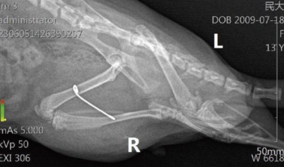 Botulinum toxin combined with static progressive stretching improves fibrous stiffness of knee joint in rats through TGF-β1/Smad pathway