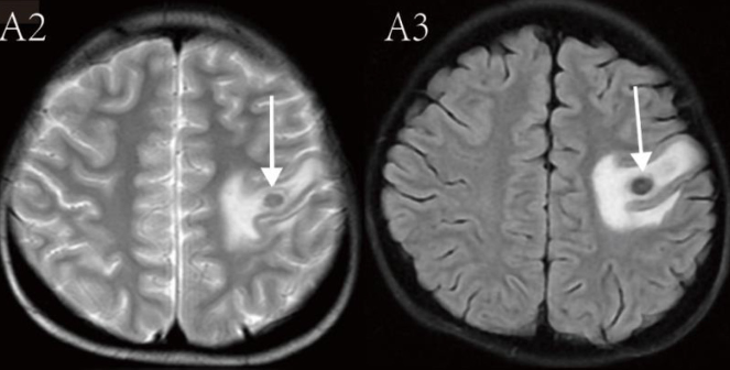 Neuroimaging in the diagnosis and treatment of cerebral toxoplasmosis in children with severe β-thalassemia after allo-HSCT