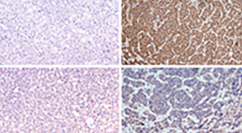Study on the mechanism of liver cancer immune escape mediated by MINDY1 through regulation of PD-L1 ubiquitination level 