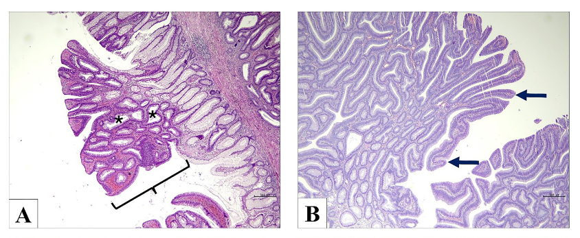 Epiplakin expression dynamics during colon carcinogenesis: Correlation with proliferation