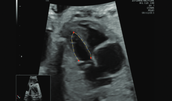 Fetal heart quantification technique improves the prenatal prediction of coarctation of the aorta: A retrospective analysis