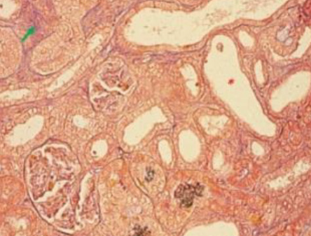 Curcumin and its combination with a reduced dose of rosuvastatin: A promising therapy for chronic kidney disease and associated dyslipidemia in rat animal models