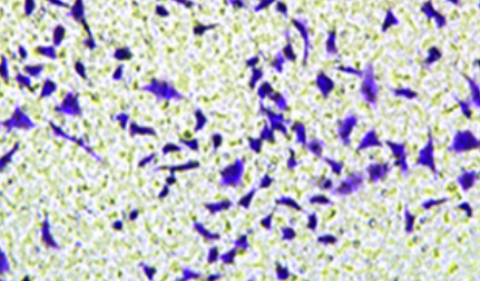 Hsa_circ_0001492 regulates the hsa-miR-145-5p/ovarian carcinoma immunoreactive antigen domain 2 axis to promote the progression of lung adenocarcinoma