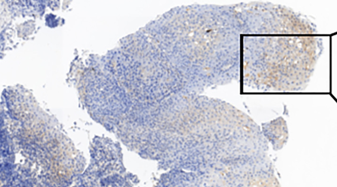 Inhibition of the long non-coding RNA MALAT1 downregulates MAP2K1 to suppress the progression of hypopharyngeal squamous cell carcinoma
