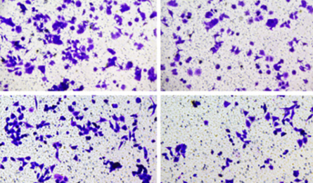 miR-145-5p regulates hepatocellular carcinoma malignant advancement and immune escape via down-regulation of AcylCoA synthase ACSL4