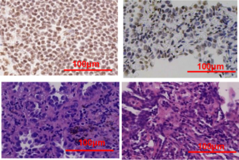 KDM3A drives NSCLC proliferation and metastasis via H3K9 demethylation, EMT activation and MMP-9 upregulation