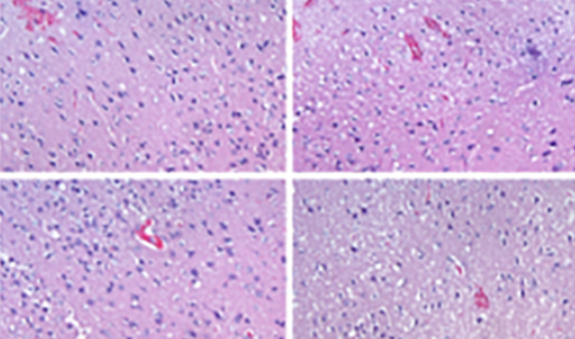 PF4 inhibits ferroptosis-mediated intracerebral hemorrhage through modulating the CXCR3/AKT1/SLC7A11 signaling pathway