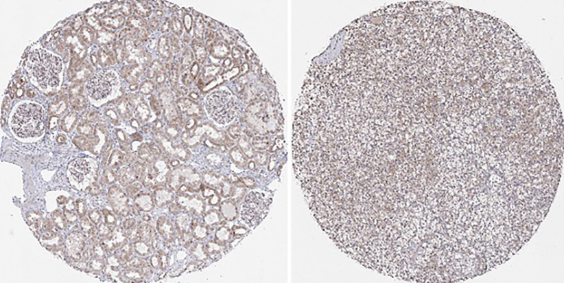 Comprehensive analysis of GPN1 in human cancer and its effects on the migration of hepatocellular carcinoma cells