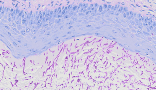 The mechanism research of itraconazole combined with aspirin in the treatment of vulvovaginal candidiasis through NF-κB signaling pathway