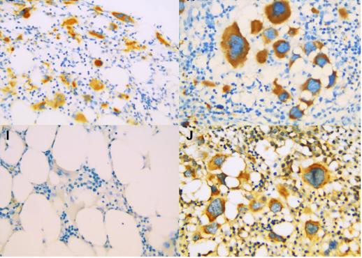 Predictive value of TGF-β1 and SMAD-7 expression at diagnosis for treatment response in low-risk myelodysplastic syndrome