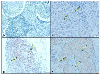 A preliminary study on the prognostic significance of cysteine-rich EGF ligand domain 2 protein (CRELD2) in patients with triple negative breast cancer