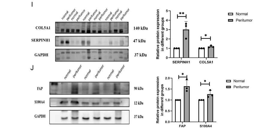 Glioblastoma induces CAF-like astrocyte activation via the AKT/mTOR–SERPINH1/COL5A1 axis