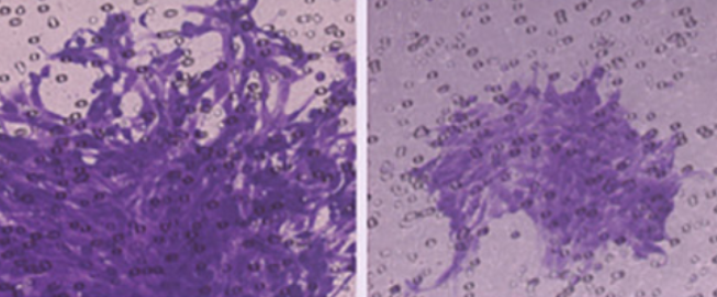 Glioblastoma induces CAF-like astrocyte activation via the AKT/mTOR–SERPINH1/COL5A1 axis
