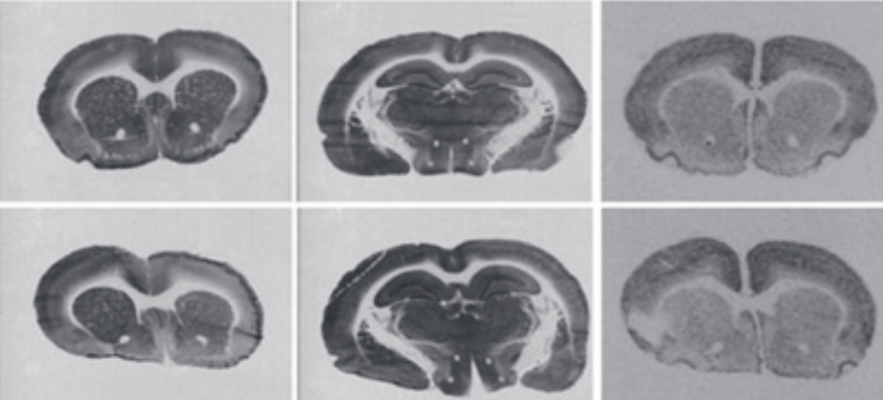 Lithium chloride could aggravate brain injury caused by 3-nitropropionic acid