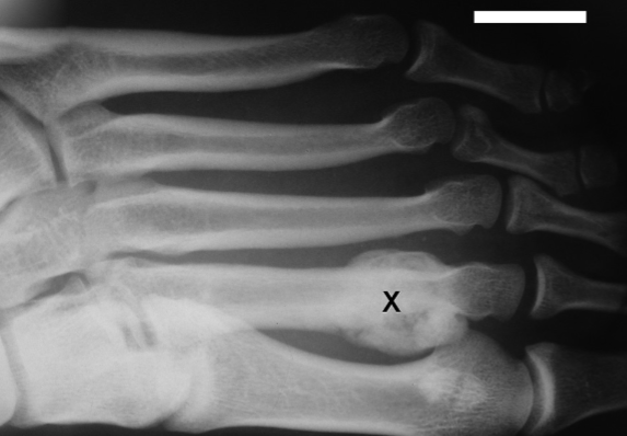 Missense splice variant (g.20746A>G, p.Ile183Val) of interferon gamma receptor 1 (IFNGR1) coincidental with mycobacterial osteomyelitis - a screen of osteoarticular lesions