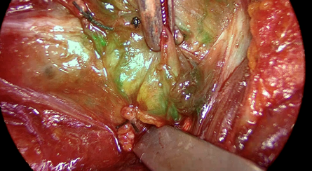 Role of indocyanine green fluorescence and inferior thyroid artery ligation in hypocalcemia after total-thyroidectomy